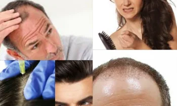 Hair Transplant Clinic İn Turkey Türkiyedeki En İyi Saç Ekim Kliniği